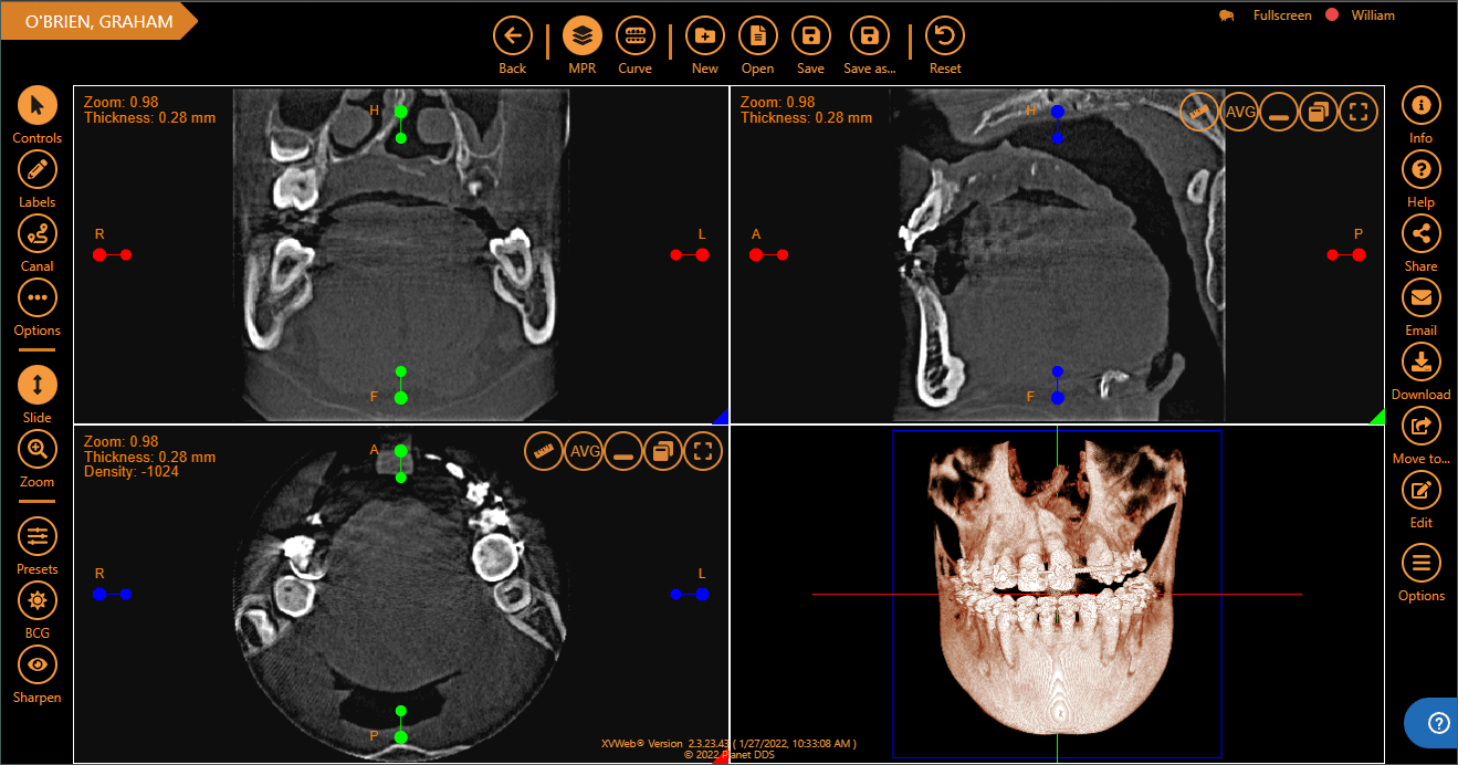 Review AI feedback for bone levels to assist in diagnosing periodontal disease.